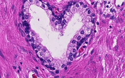 Bilddiagnostik vid lobulär bröstcancer